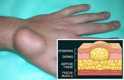 Lump Under Skin On Hand: Lipoma. A collection of fatty tissue causes and lump on back of hand. Image from Researchgate