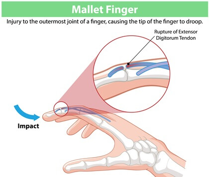 Mallet Finger: Impact through the fingertip forces it to bend too far, tearing the extensor digitorum tendon