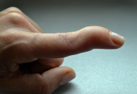 Mallet Finger: Causes, symptoms, diagnosis and treatment of baseball finger