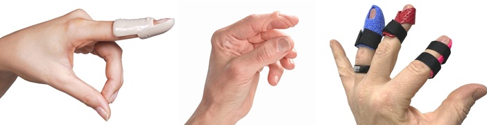 Types of Mallet Finger Splint: Stack Splint, Oval 8 Splint and Thermoplastic Splint