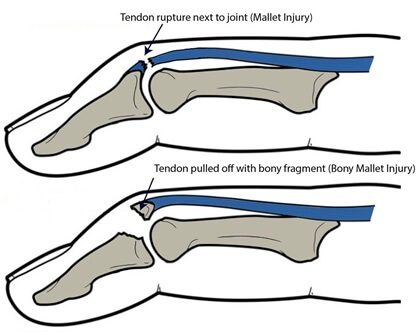 Mallet Finger where the extensor tendon ruptures vs Bony Mallet Finger where part of the bone is pulled off (avulsion)