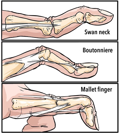 Mallet Finger vs Swan Neck vs Boutonniere Deformity: See the differences at the finger joints Mallet Finger vs Swan Neck vs Boutonniere Deformity: See the differences at the finger joints