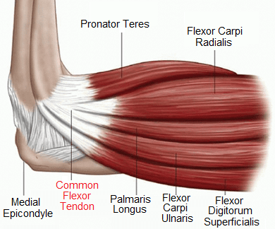 Golfers Elbow (Medial Epicondylitis): Causes, Symptoms & Treatment