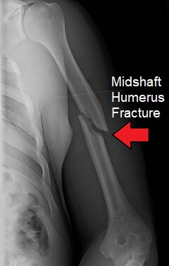 Humerus Fracture: Causes, Symptoms & Treatment