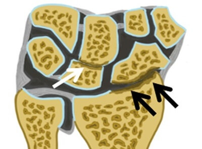 Arthritis is a common cause of pain back of hand. Find out about the common symptoms and treatment options