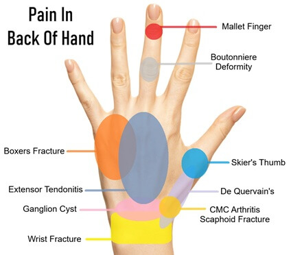 Back Of Hand Pain Diagram: Find out about the common causes and how to treat them with our pain in back of hand chart
