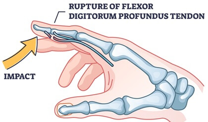 Jersey Finger is a common cause of pain in finger from tendon damage, resulting in difficulty bending the fingertip. Find out about the causes, symptoms and treatment options
