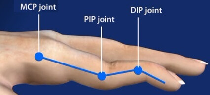 Pain In Finger Joints: Swan Neck Deformity. Causes, symptoms and best treatment options