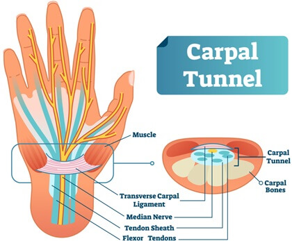 Pain In Wrist & Palm: Carpal Tunnel Syndrome is a common cause of pain in palm of hand. Find out about the common causes, symptoms and best treatment options