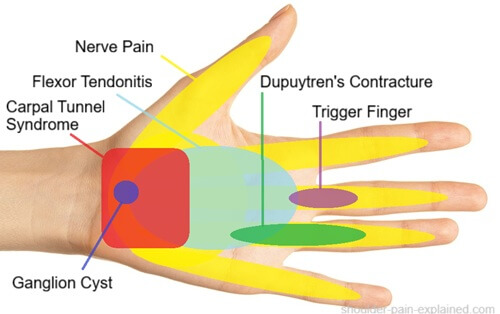 Pain In Palm Of Hand Diagram: Chart showing common causes of hand pain on palm. Find out about the common causes, symptoms and best treatment options