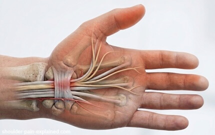 Pain In Thumb: Carpal Tunnel Syndrome. Find out about the causes, symptoms, diagnosis of pain in the thumb from carpal tunnel syndrome