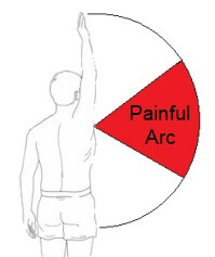 A painful arc is a common feature of shoulder impingement.  Shoulder movement is usually full and only the middle range of movement is painful (shown in red)