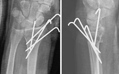 Percutaneous Pinning Distal Radial Fractures