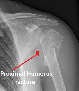 Proximal Humerus Fracture: Causes, Treatment & Recovery
