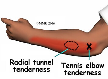 Radial Tunnel Syndrome vs Tennis Elbow Symptoms