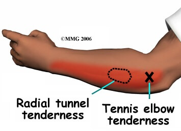 Radial Tunnel Syndrome: Causes, Symptoms & Treatment