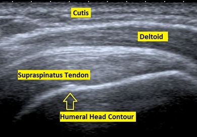Ultrasound scan showing the supraspinatus tendon of the rotator cuff