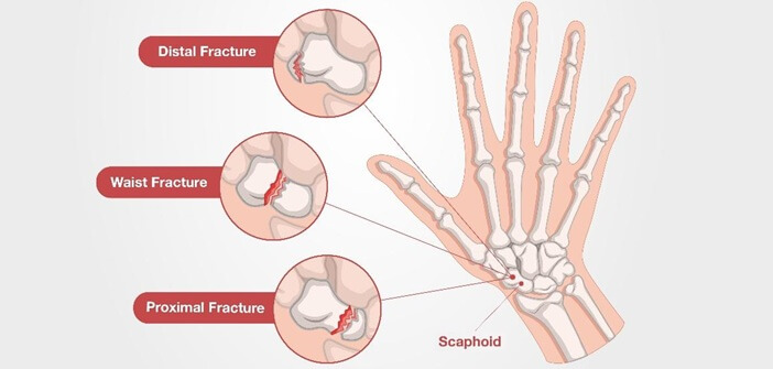 Types Of Scaphoid Fracture: Distal pole fracture, waist fracture and proximal pole fracture