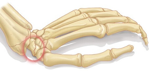 Scaphoid Fracture Wrist: Symptoms, causes, diagnosis and treatment of scaphoid bone fractures