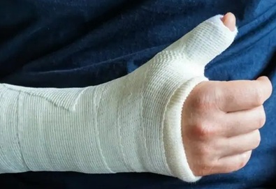 Scaphoid Wrist Fracture Cast: the cast typically runs from the hand to the elbow and includes the thumb