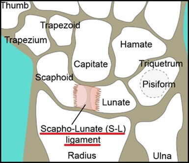 A scapholunate ligament injury can result in pain in the middle of the wrist. A scapholunate ligament injury can result in pain in the middle of the wrist.