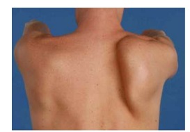 A winged scapula is often visible with brachial neuritis, caused by muscle wasting