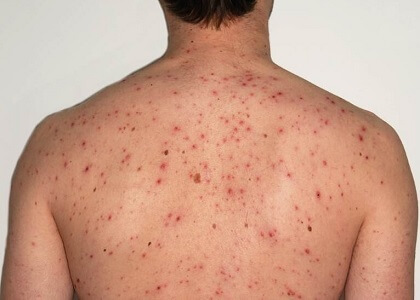 Arm Shoulder Acne Causes Treatment