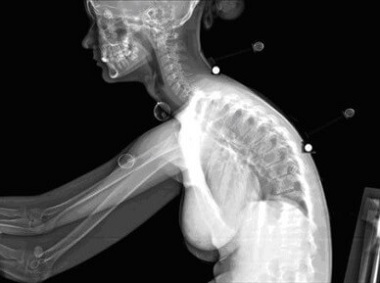 Spending long periods slumped over in poor posture can lead to upper back pain between the shoulder blades