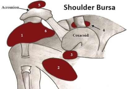 Shoulder bursa: (1) subacromial bursa and (6) subdeltoid bursa (which tend to be connected), (2) subscapular bursa, (3) subcoracoid bursa, (4) coracoclavicular bursa and (5) supraacromial bursa.
