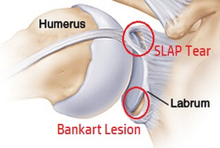 Shoulder Clicking, Popping, Cracking & Grinding: Causes & Treatment
