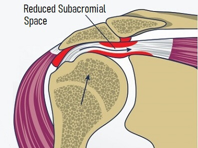 shoulder impingement diagnosis