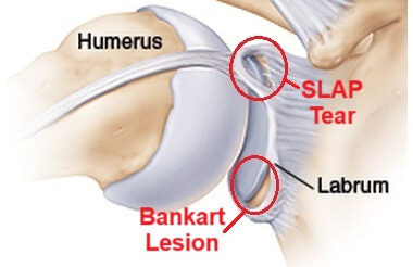 Shoulder Labrum Tears: SLAP Tear & Bankart Lesion Shoulder Labrum Tears: SLAP Tear & Bankart Lesion