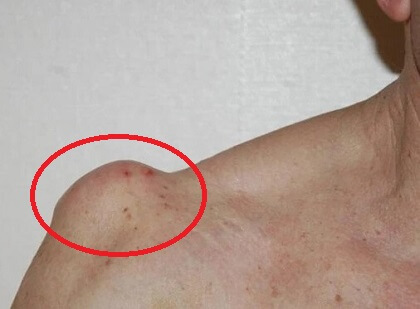 Shoulder Lump On Top: ACJ Cysts. Causes, symptoms, diagnosis and treatment for lumps of top of the shoulder from ACJ problems