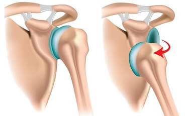 Recurrent shoulder dislocations are a common problem with a Bankart lesion due to the decreased stability.