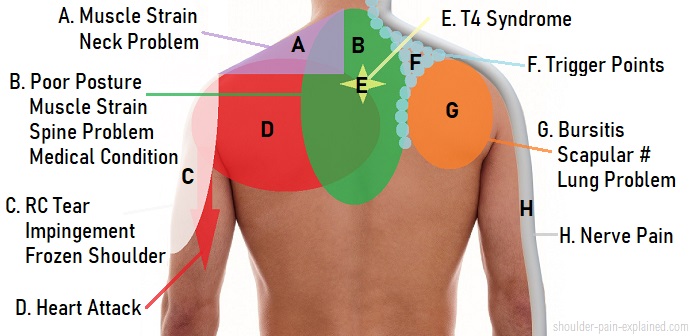 Shoulder Symptom Chart