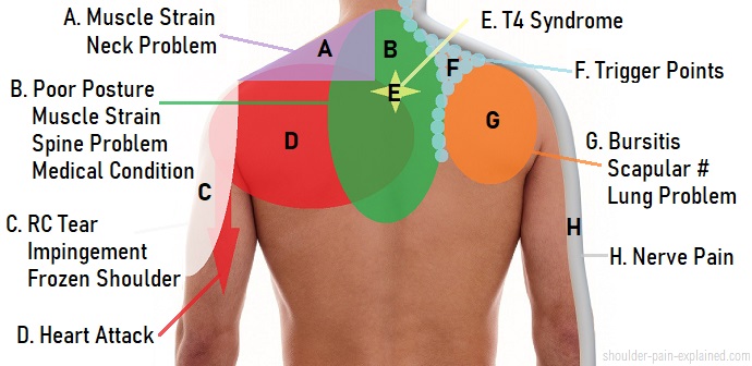 Shoulder Pain Diagnosis Chart