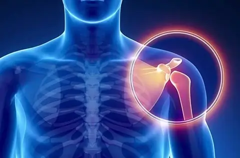 Shoulder Pain Diagnosis: Common causes of shoulder pain including rotator cuff tears, shoulder impingement syndrome, shoulder bursitis and fractures. Shoulder Pain Diagnosis: Common causes of shoulder pain including rotator cuff tears, shoulder impingement syndrome, shoulder bursitis and fractures.