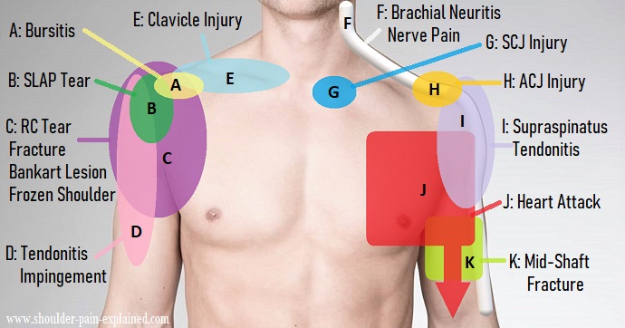 Shoulder Pain, Shoulder Injury