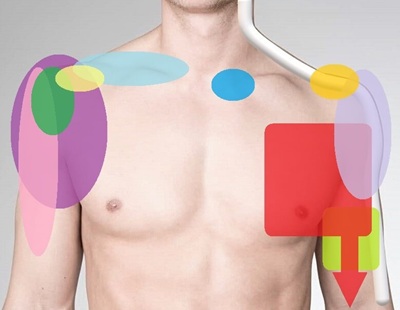 Shoulder Pain Diagram: Find out what is causing your pain with our shoulder pain diagnosis charts Shoulder Pain Diagram: Find out what is causing your pain with our shoulder pain diagnosis charts