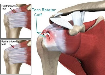 Shoulder Pain Explained: Common Shoulder Injuries & Conditions