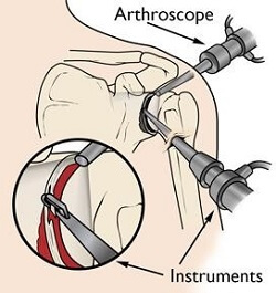 Arthroscopic subacromial decompression surgery for shoulder impingement