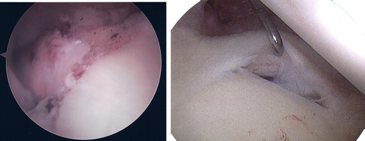 SLAP Tears of the Shoulder. Type 1 SLAP Tear: note the frayed edges, indicative of degeneration of the glenoid labrum. Type 3: note the clean tear SLAP Tears of the Shoulder. Type 1 SLAP Tear: note the frayed edges, indicative of degeneration of the glenoid labrum. Type 3: note the clean tear