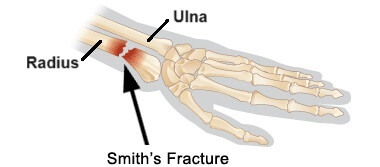 Smith Distal Radius Fracture: Causes & Treatment