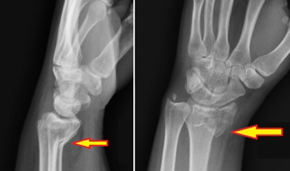 Smith Fracture X-ray