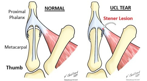 Stener Lesion associated with UCL tear thumb from Skiers Thumb. WikiSM