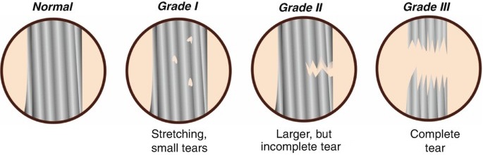 Grades of UCL injury: grade 1-3 tears of the ulnar collateral ligament of the elbow Grades of UCL injury: grade 1-3 tears of the ulnar collateral ligament of the elbow