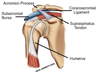 Subacromial Bursa: Inflammation of the bursa is known as subacromial bursitis