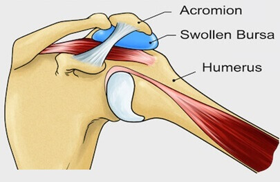 Subacromial Bursitis Inflammation: Causes, symptoms and treatment