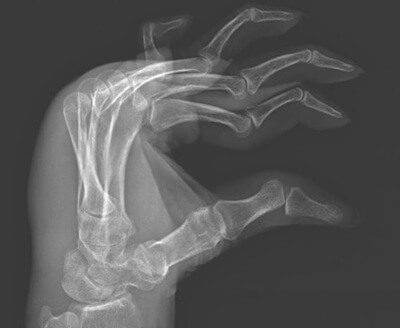 Swan Neck Deformity Xray: MCP flexion, PIP hyperextension and DIP flexion