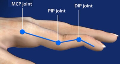 Swan Neck Deformity: MCP flexion, PIP hyperextension, DIP flexion Swan Neck Deformity: MCP flexion, PIP hyperextension, DIP flexion